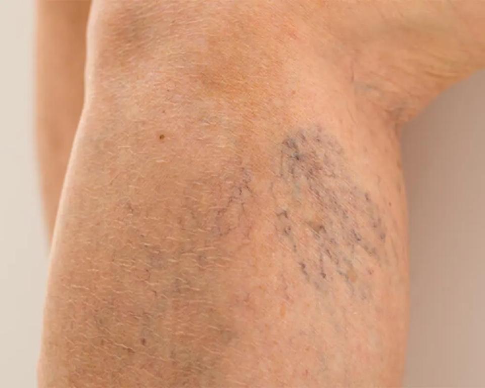 Varis Tedavisinden Sonra Nelere Dikkat Etmek Gerekir?