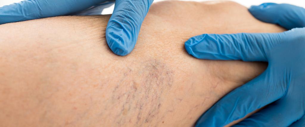 Varislerde Lazer Tedavisi Nedir, Avantajları Nelerdir?