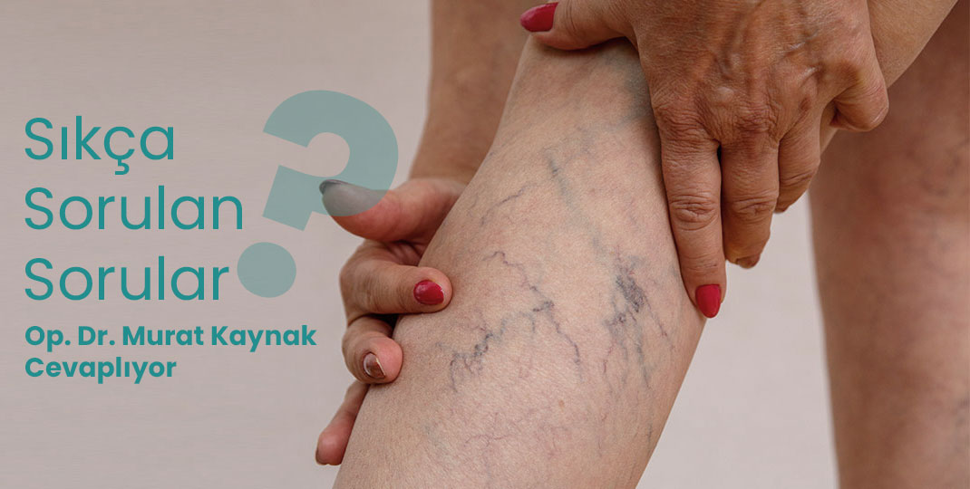 Gün sonunda bacaklarım şişiyor, lipödem olabilir mi?